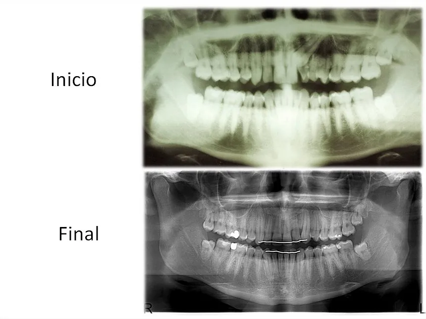 Ortodoncia Carlton ortodoncia invisible 5