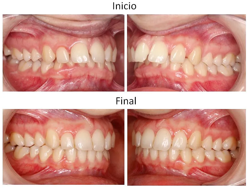 Ortodoncia Carlton ortodoncia invisible 11