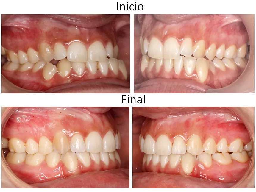 Ortodoncia Carlton ortodoncia invisible 18