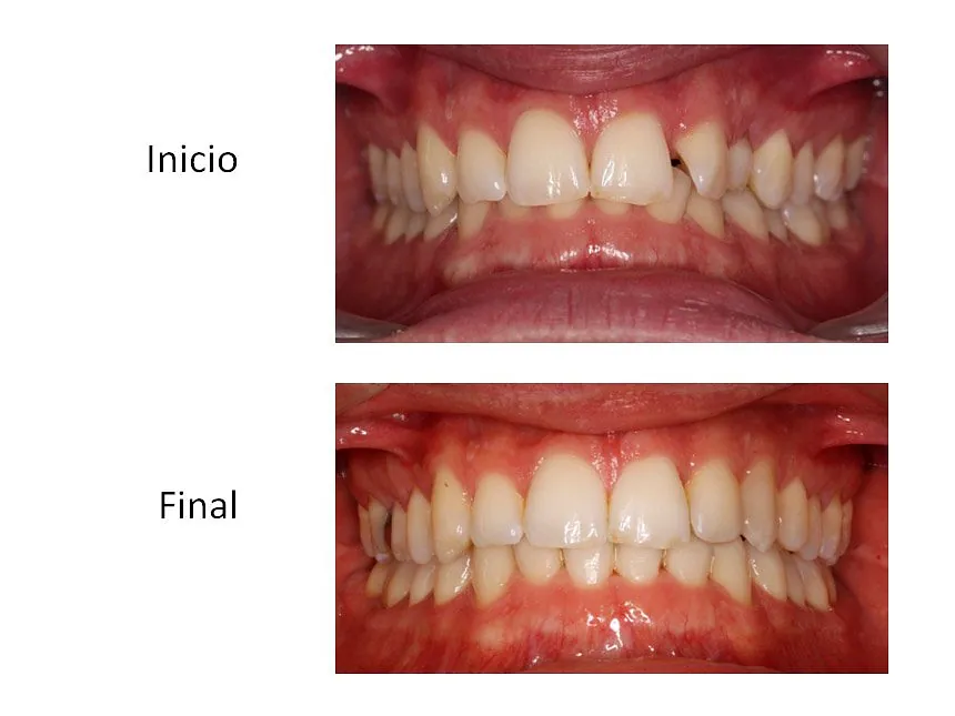 Ortodoncia Carlton ortodoncia invisible 4