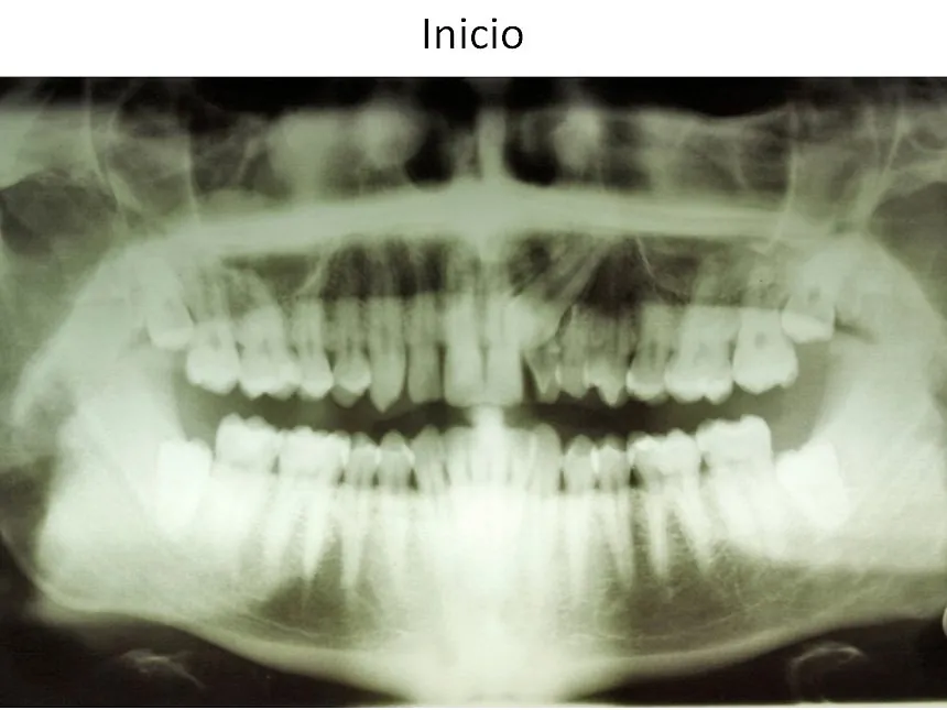 Ortodoncia Carlton ortodoncia invisible 1