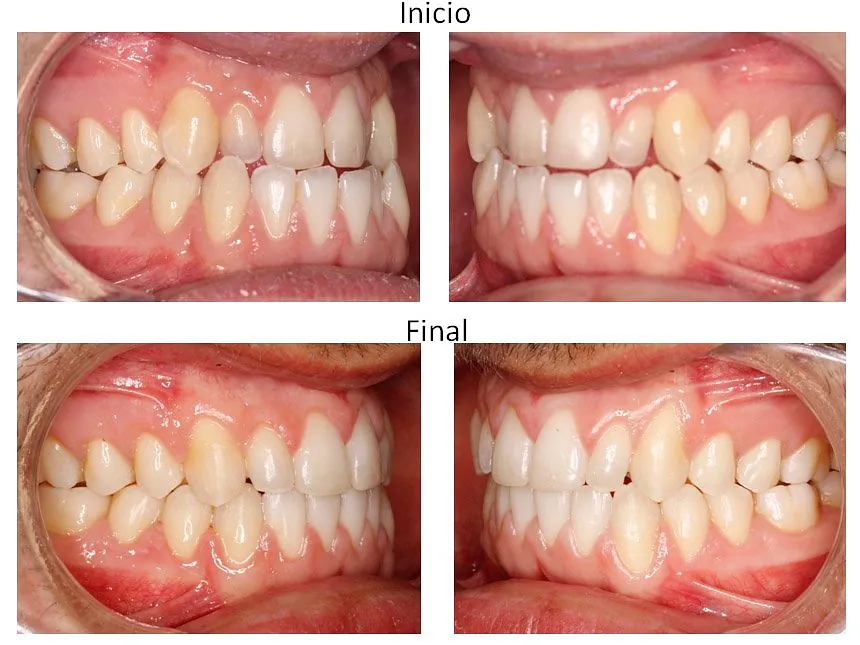 Ortodoncia Carlton ortodoncia invisible 6