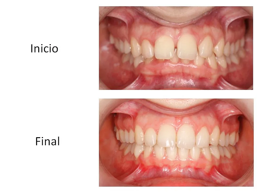 Ortodoncia Carlton ortodoncia invisible 10